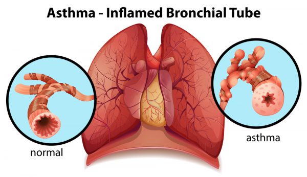 Asthma Inflamed Bronchial Tube